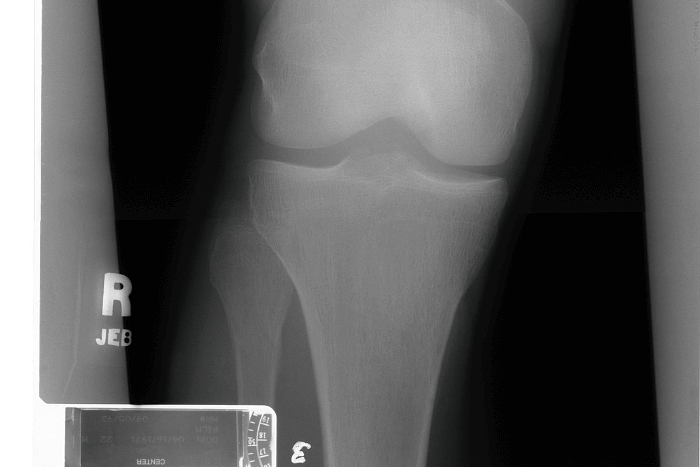 Taking Care of Patients Post Knee Replacement